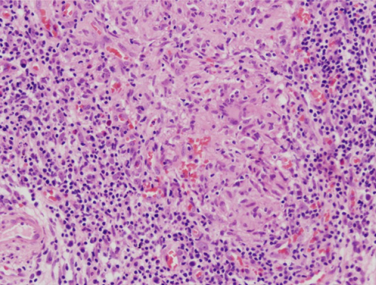 Figure 2. H&E, 20x Epitheloid granuloma with langerhans giant cells