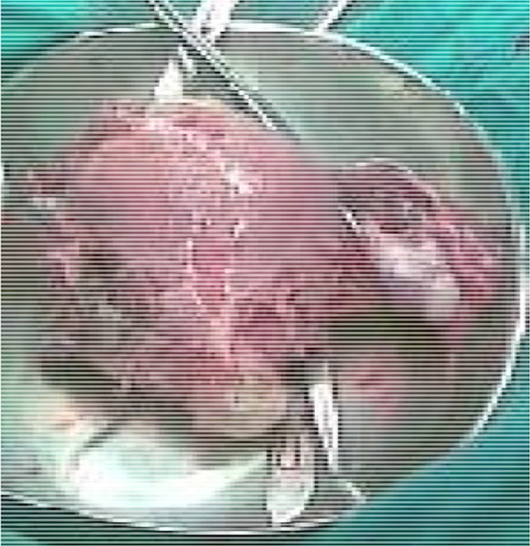 Figure 2. Enlarged uterus, ovarian metastasis, perforation of uterus, and myometrium invasion