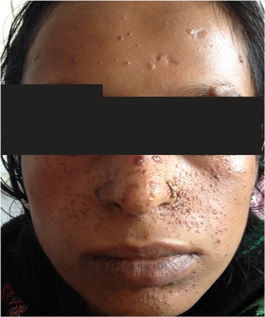 Figure 1. Picture showing adenoma sebaceum