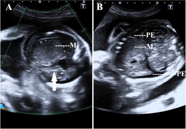 Figure 3. A 23 year old primi of tuberous sclerosis with fetal cardiac rhabdomyoma at 31 weeks of gestation resulting in IUFD. A: Color Doppler ultrasound showing absent cardiac activity (arrow), note the mass (M) and subcutaneous edema. B: Ultrasoun