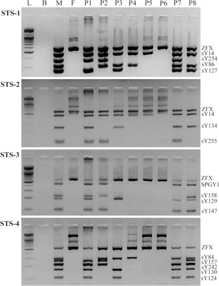 Figure 1. The microdeletion types of the azoospermia factor (AZF) regions in the Y chromosome by multiplex PCR analysis with STS markers. L: 100 bp DNA ladder; B: blank; M: male positive control, F: female negative control, P1: AZFa deleted patient;