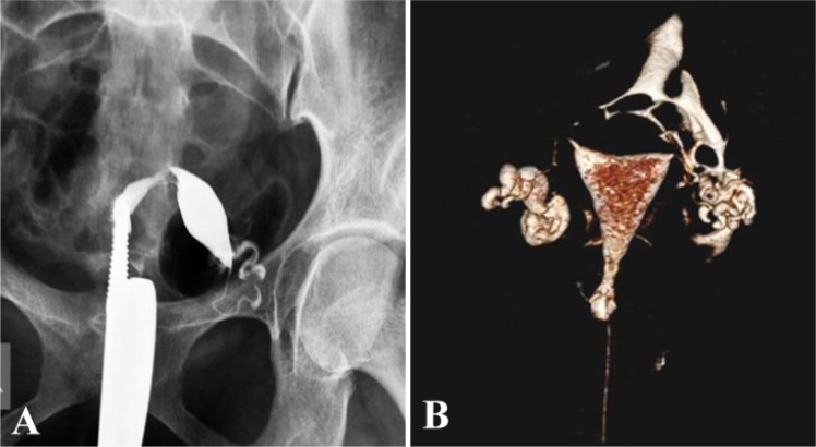 Figure 2. A: Abnormal uterine position on HSG shows a spindle shaped uterine cavity deviated towards left with patent left fallopian tube. Right fallopian tube is not seen. Findings are suggestive of a unicornuate uterus on HSG. B:VRT image from MDCT