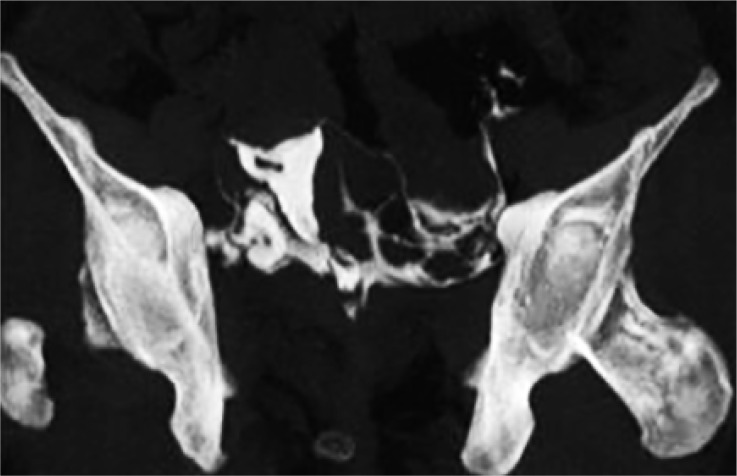 Figure 3. MIP image from a patient shows evidence of linear filling defect within the contrast filled uterine cavity suggestive of intrauterine adhesion