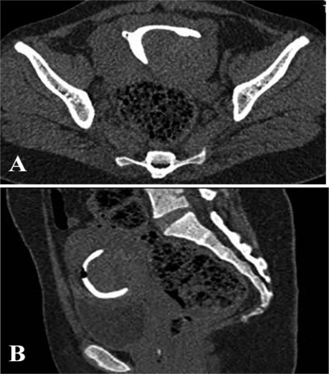 Figure 4. A: Axial and figure B: Sagittal MPR image show a large broad based postero-lateral filling defect within the contrast filled uterine cavity suggestive of a submucosal leiomyoma