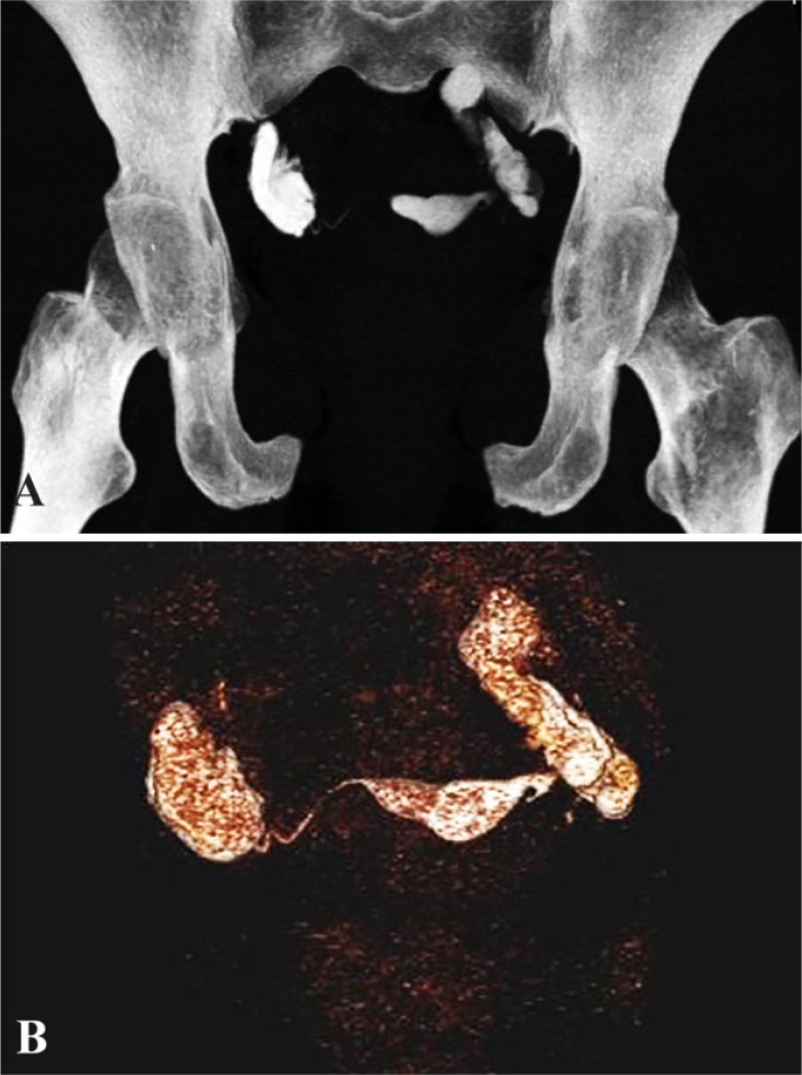 Figure 5. A: MIP and figure B: VRT image showing bilateral hydrosalpinx with minimal spill on right side
