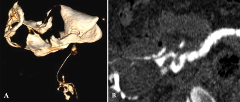 Figure 6. A: VRT shows normal uterus with patent right fallopian tube with peritubal spill and left tubal block; B: Curved MPR excellently unfolds the convoluted right fallopian tube which shows evidence of beading and irregular outline suggestive of