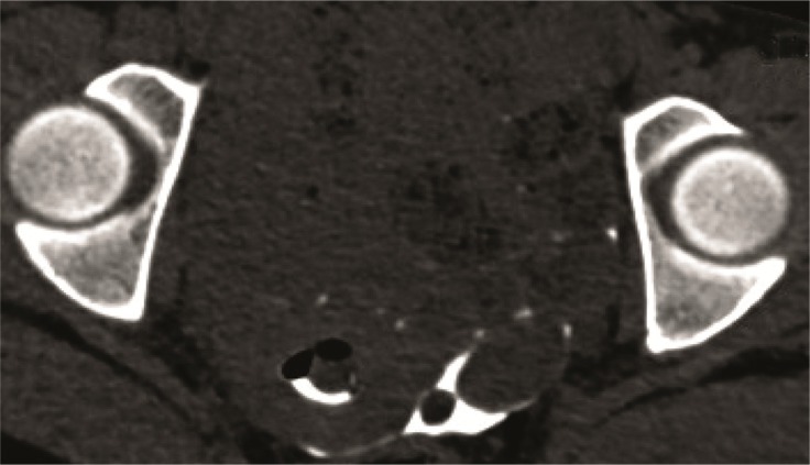 Figure 7. MIP image shows the left ovary as an oval structure delineated by the contrast spill. A round soft tissue density lesion noted postero-medial to the ovary was confirmed as an endometriotic deposit on laparoscopy