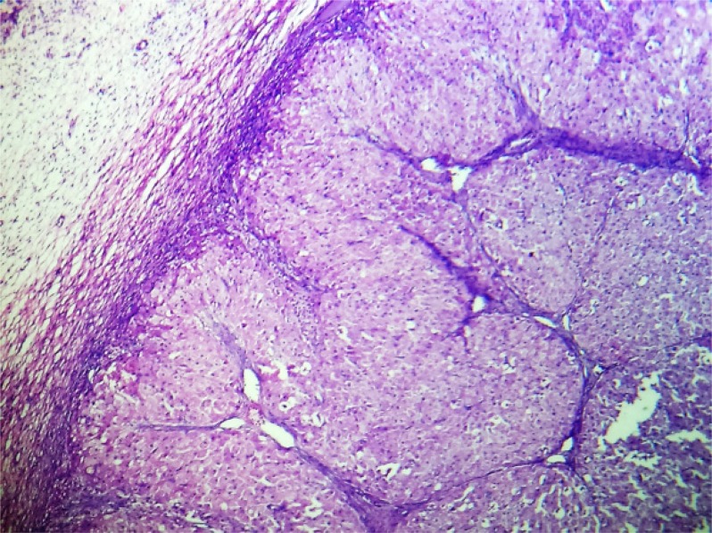 Figure 3. Well circumscribed solid mass of luteinized cells replacing ovarian tissue, seen at the periphery (H&E, ×100)