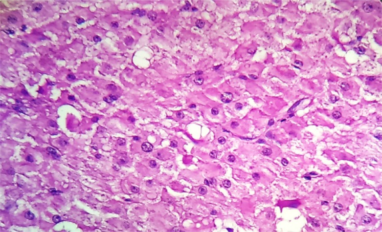 Figure 4. The cells were moderate in size having abundant eosinophilic cytoplasm and central nuclei. Few of these showed prominent nucleoli (H&E, ×400)