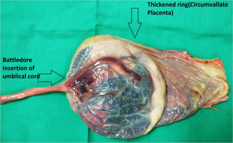 Figure 1. Coexistent Battledore insertion of umbilical cord and circumvallate placenta