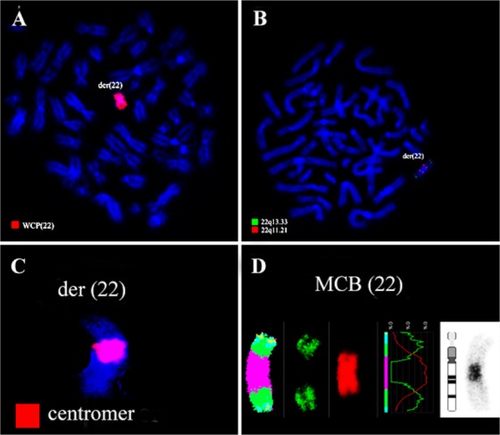 Figure 2. Karyotype and chromosomal aberrations were confirmed using molecular cytogenetic approaches. (A) A robertsonian translocation rob (22;22) was identified using the whole chromosome painting probe (B). Application of the probe Di-George probe