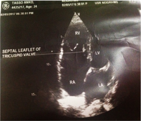 Figure 1. The lesion of tricuspid regurgitation with a small right ventricle