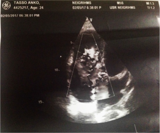 Figure 2. The ECHO findings of the patient. The findings are suggestive of severe tricuspid regurgitation