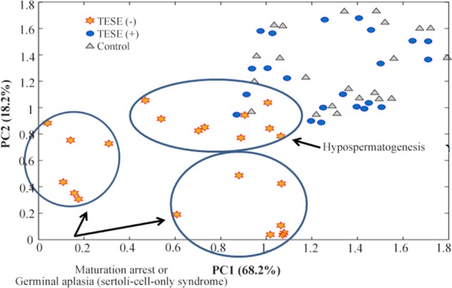 Figure 2. PCA analysis of Raman spectra gives a possible subdivision of TESET(−) groups. TESE(−) group are subdivided to hypospermatogenesis, maturation arrest and germinal aplasia (Sertoli-cell-only syndrome) based on the position in the graph