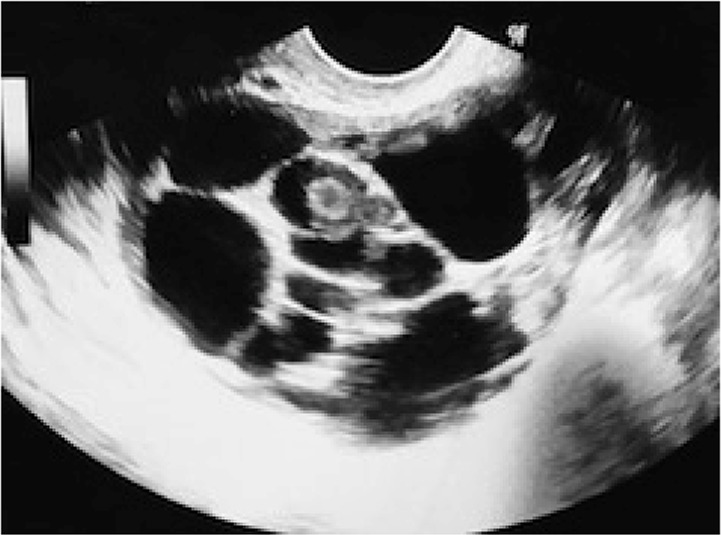 Figure 1. Transvaginal ultrasound image of the ovary before stimulation