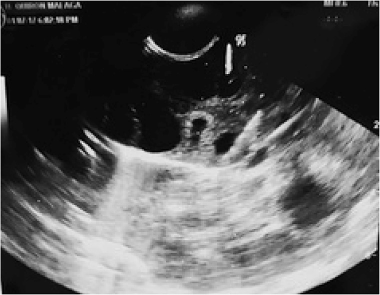 Figure 4. Ultrasound image during guided needle follicular aspiration
