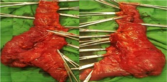 Figure 1. Postoperative specimen of the bowel. The mass is visible at cecum segment