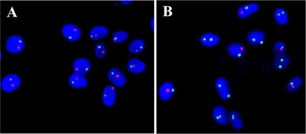 Figure 1. Sperm Aneuploidy by FISH. A: The picture showing the normal signal pattern of chromosome 13 (green) and 21 (red) on sperms. B: Normal signal pattern of chromosome X (green), Y (red) and 18 (Aqua) on sperm
