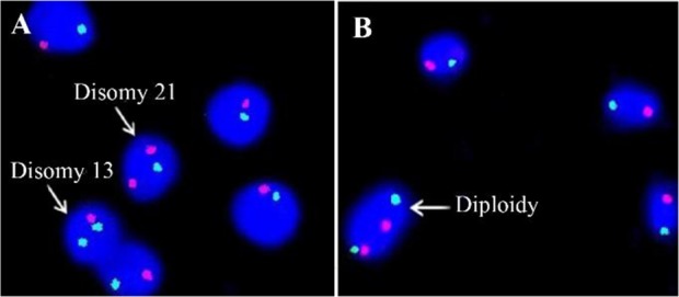 Figure 2. Sperm Aneuploidy by FISH. A: Sperm FISH picture showing disomy for chromosomes 13 (green) and 21 (red). B: FISH picture showing diploidy for chromosomes 13 and 21