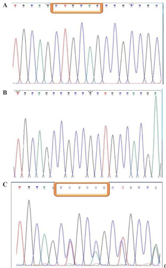 Figure 4. Direct sequencing of exon 1. A: homozygote for the 6bp insertion, B: homozygote without the insertion, C: heterozygote for the 6bp insertion
