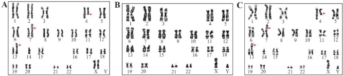 Figure 2. G-banded karyotype images of (A) Mother -45 XX, t (4;7) (q27;p22) rob (13;14) (q10;q10) (B) Father -46 XY Normal (C) Proband (child) -45 XY, t (4;7) (q27;p22) rob (13;14) (q10;q10)