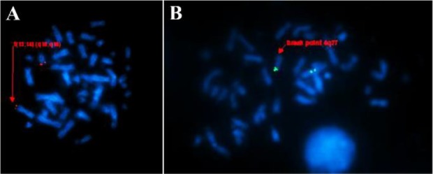 Figure 3. Image showing the Fluorescent in Situ Hybridization on metaphase of proband -45 XY, t (4;7) (q27;p22) rob (13;14) (q10;q10). A) Metaphase image showing the translocation of chromosome 13 and 14, B) Metaphase image showing the breakpoint on