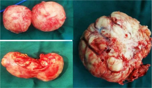 Figure 1. Different myomas; A: 3 cm, B: 8 cm, D: 18 cm