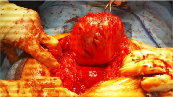 Figure 2. Abdominal wall leiomyoma
