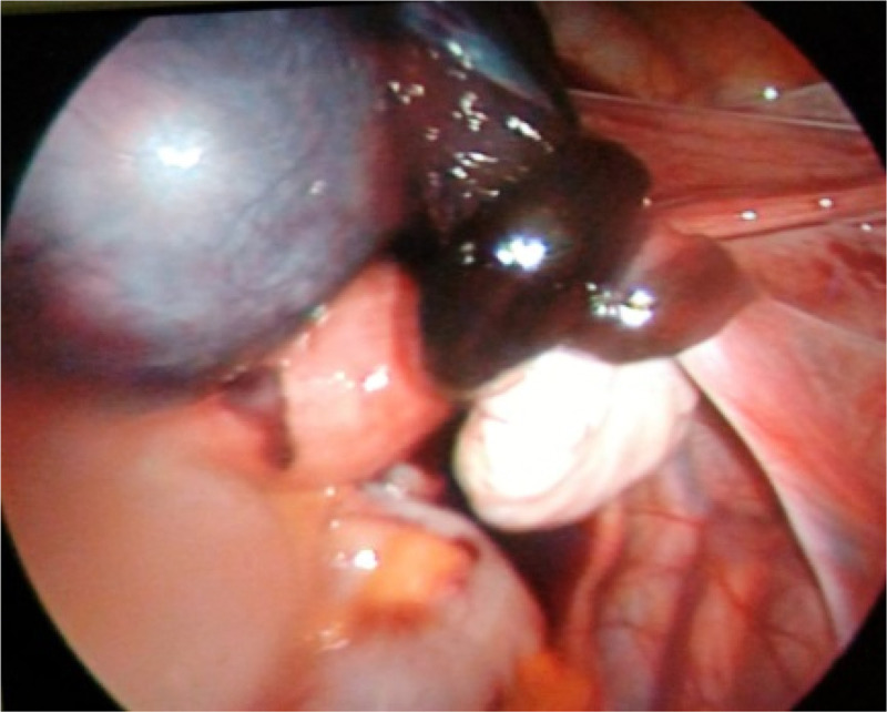Figure 1. Isolated torsion of the right fallopian tube