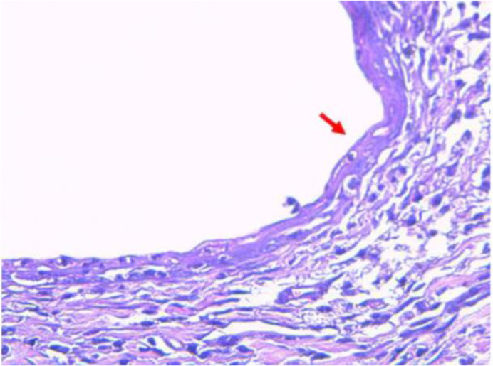 Figure 2. Hematoxylin-eosin (HE) staining of rat surgically-induced endometriosis (40× magnification). HE staining from our previous study proved that endometrial cyst induced with autotransplantation was truly an endometriosis tissue. The red arrow 