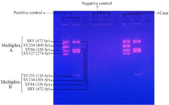 Figure 3. Multiplex-STS PCR picture showing no deletion in AZF region in both positive control (left panel) and SCOS case (right panel). No AZF region was present in negative control (middle panel)