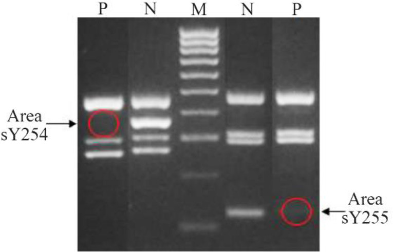 Figure 4. Microdeletion of the patient (P=patient; N=normal; M=marker)