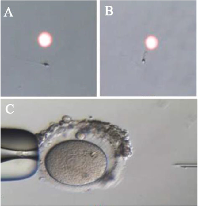 Figure 7. A) Before LAISS procedure; B) After LAISS procedure; C) ICSI procedure. Note that the spermatozoon’s tail is curled after LAISS, indicating a viable state of spermatozoon