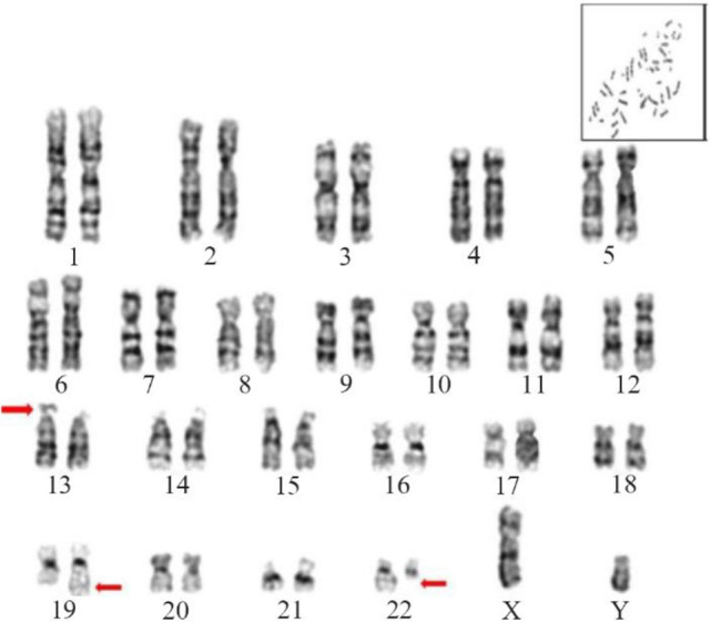 Figure 2. Karyotype analysis: GTG-banded chromosomal analysis of the proband, which reveals the presence of a balanced translocation involving chromosome 19 and 22 along with chromosome 13 ps+.