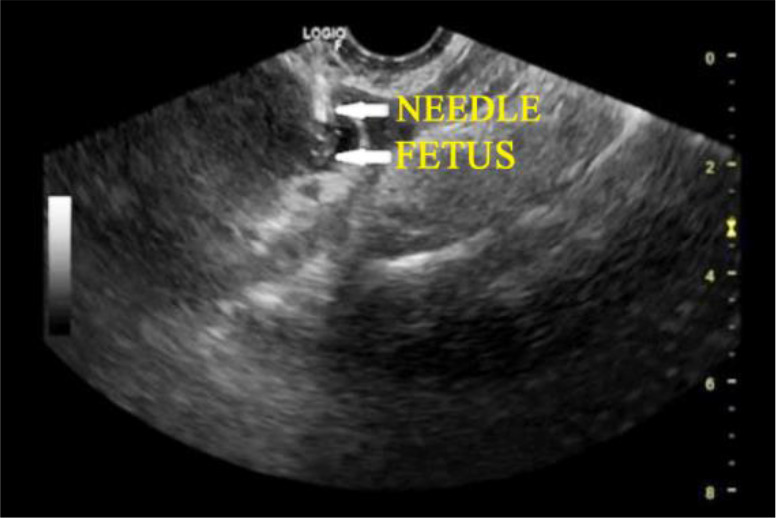 Figure 1. Transvaginal ultrasound guided intrafetal injection of KCL and methotrexate instillation