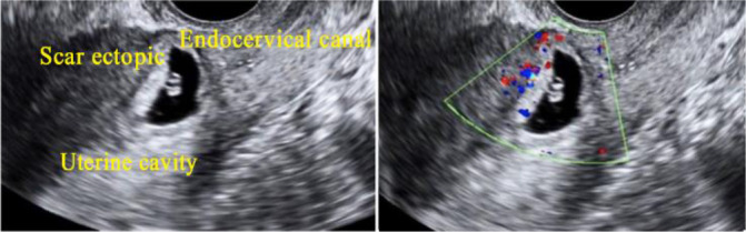 Figure 7. Ultrasound showing empty uterine cavity and endocervical canal. Ectopic pregnancy seen at the level of previous caesarean scar. Doppler study shows increased vascularity
