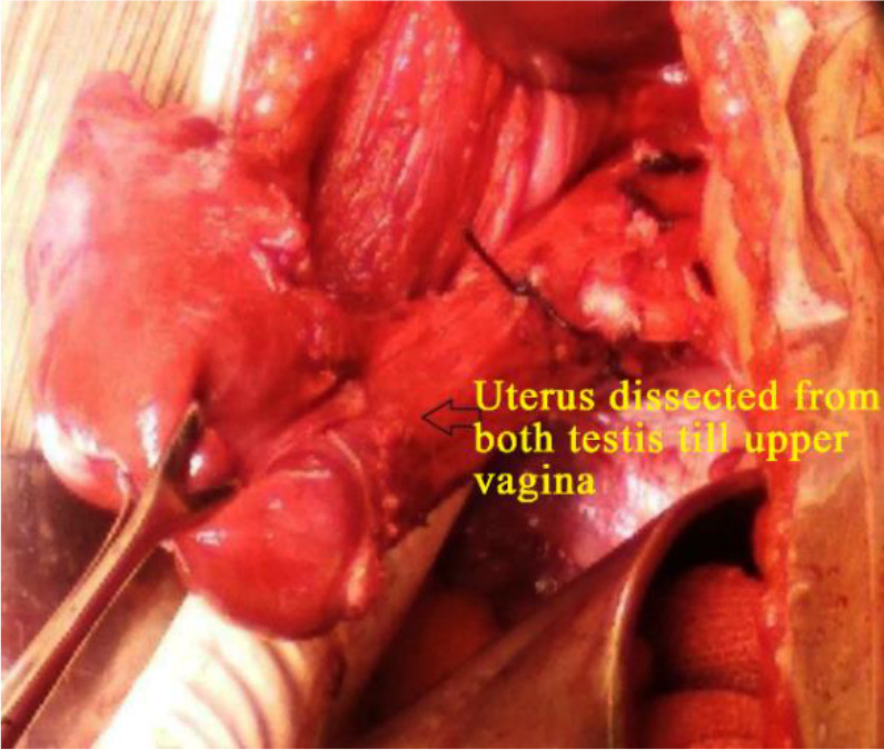 Figure 2. Intraoperative image showing dissected uterus from both testicles till upper vagina