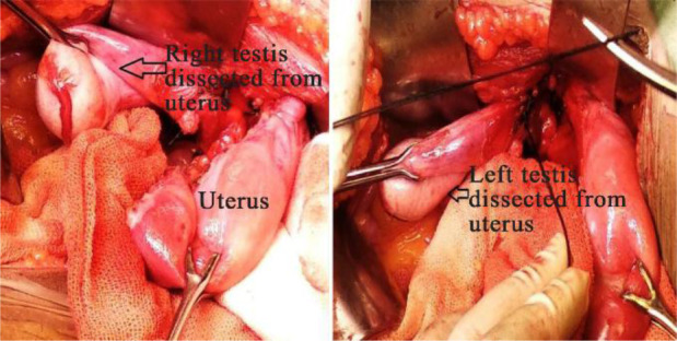 Figure 3. Intraoperative image showing dissected right and left testis from uterus