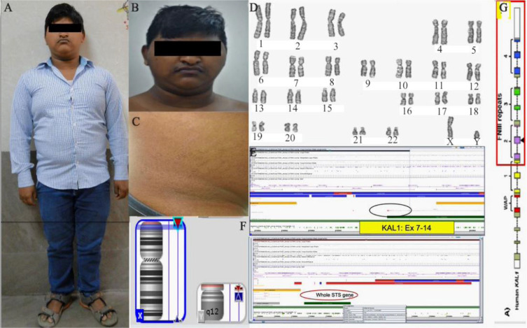 Figurer 1. A, B) Patient with Kallmann syndrome, C) Mild ichthyosiform lesion in the abdomen, D) Karyotype report of the patient showing extra material on p arm of chromosome X, E) Cytogenetic microarray of the patient showing complete deletion of ST