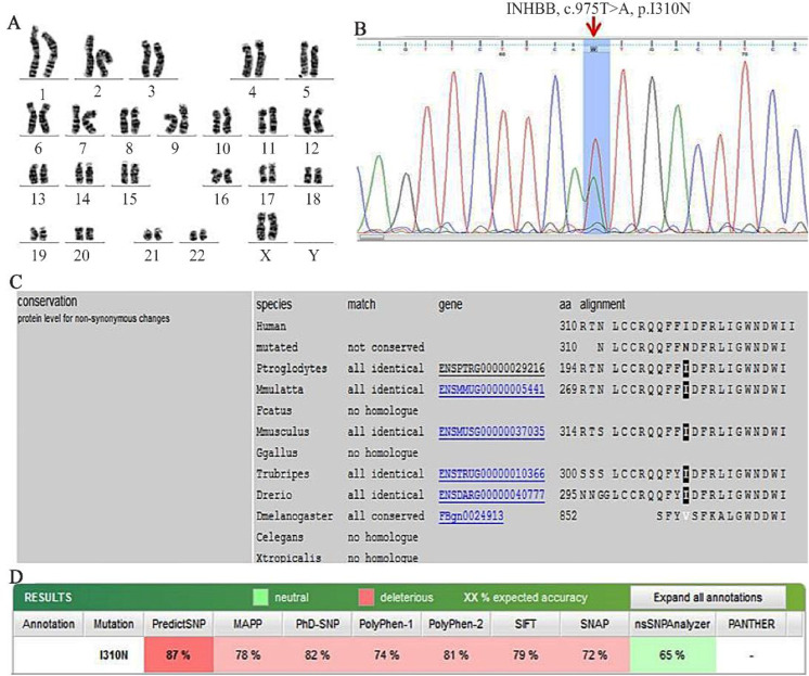 Figure 2. A) Representative karyotype (46,XX) of case 1, B) Electropherogram of the c.975T>A (p.I310N), C) The multiple sequence alignment of the p.I310N mutant protein reveals the conservation of isoleucine at this position throughout evolution,