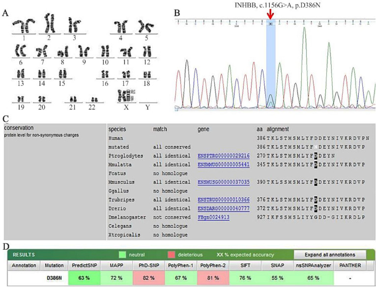 Figure 3. A) Representative karyotype (46,XX) of the second case, B) Electropherogram of the c.1156G>A (p.D386N), C) The multiple sequence alignment of the p.D386N mutant protein reveals the conservation of isoleucine at this position throughout e