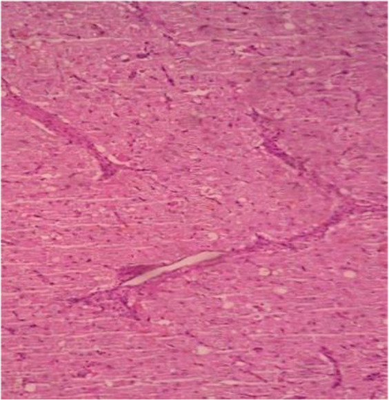 Figure 2. H&E stained section of luteoma