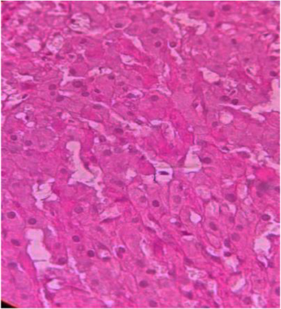 Figure 3. PAS stained section of luteoma