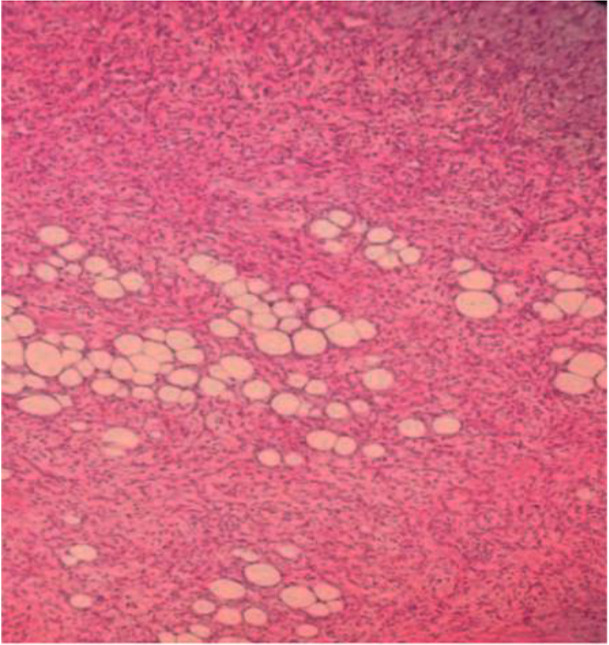 Figure 4. H&E stained section of uterine leiomyoma