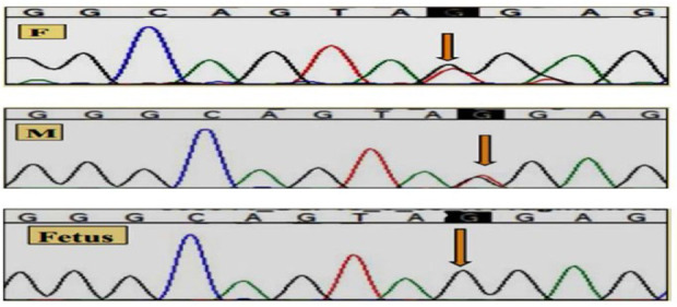 Figure 2. Parents (F and M) whole exome sequencing (WES) indicating heterozygous USP18(+) Exon 9 c.906 T>G (p.Tyr 302 Ter) and fetal WES indicating homozygous USP18(+) Exon 9 c.906 T>G (p.Tyr302 Ter)