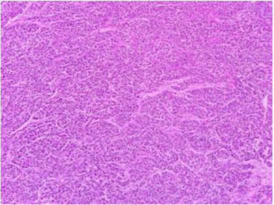 Figure 1. Monomorphic cells in regular nests and a hyper-vascular background including microvasculature separating cellular nests
