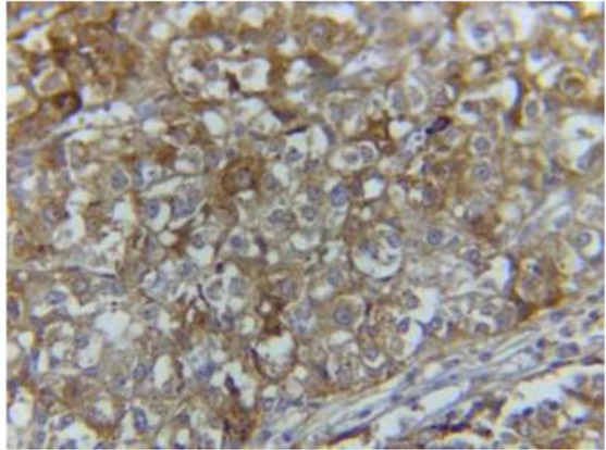 Figure 4. Fibrotic bands with lobular pattern in tumor