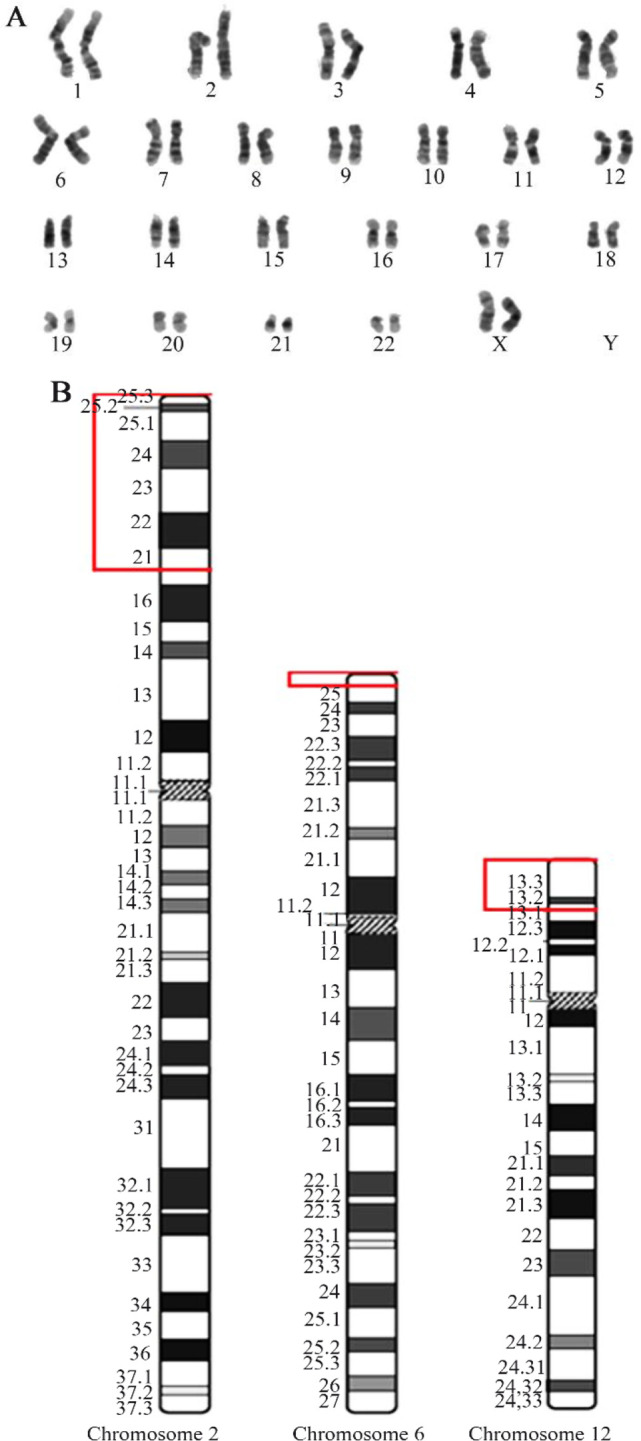 Figure 3. A) karyotype analysis of the mother, GTG-banded chromosomal analysis reveals the presence of a balanced translocation involving chromosome 2, 6, and 12; B) the exchanged segments were represented in ideogram