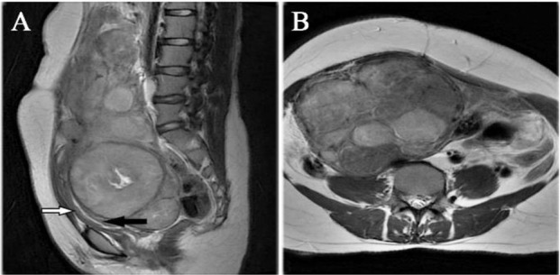 Figure 1. A) Sagittal T2 w image showing multiple fibroids in posterior wall of uterus and cervix with endometrial canal compressed anteriorly (black arrow), and anterior uterine wall (white arrow). B) Axial T2w image showing multiple fibroids in fun