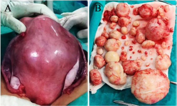 Figure 2. A) Intraoperative image showing grossly enlarged uterus with multiple fibroids. B) Removal of 75 fibroids